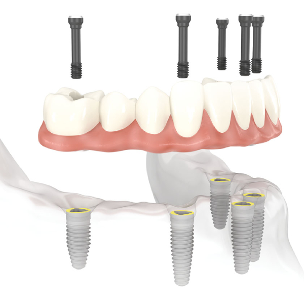 comparison-of-dental-implant-and-dental-bridge